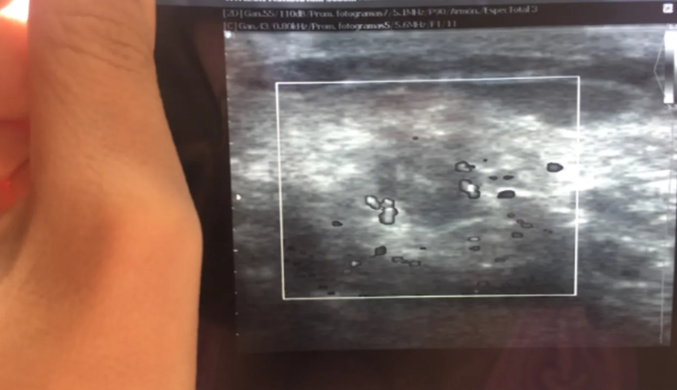 Radiografia_cáncer_de_mama