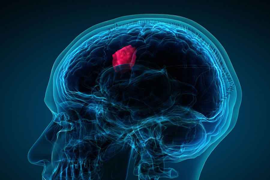 Los tumores cerebrales son crecimientos de células anormales en los tejidos del cerebro .