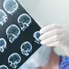 Egresado del Tec de Monterrey desarrolla bisturí inteligente que detecta tumores cerebrales