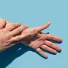 How do you catch monkeypox?
