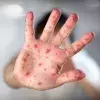 What is measles? Symptoms, prevention, and about the health alert