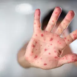 What is measles? Symptoms, prevention, and about the health alert